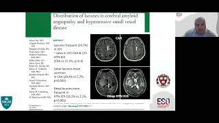 Lacunar Ischaemic Stroke  Clinical Perspectives [upl. by Nace]