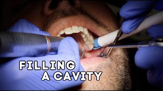 How Does A Dentist Fill A Cavity [upl. by Ahsinauj449]