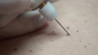 Hyperkeratosis removal with Plexr [upl. by Cherlyn]