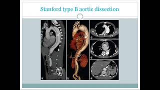 Cardiac CT scan  3D CT angiogram basic overview use contrandications findigns for USMLE [upl. by Ilrebma366]