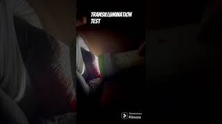 Transillumination test for hydrocele clinical examination neetpg motivation pgprep surgery [upl. by Nnylf637]