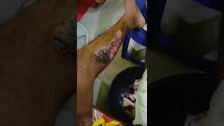 SKIN GRAFTING DRESSING AFTER 15 DAYS LEFT LEG🦶 OF A YOUNG BOY INJURY IN ACCIDENTAGE24 [upl. by Gibun]