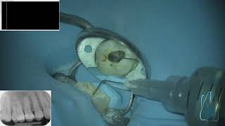 LIVE ENDODONTIC TREATMENT  first upper molar 40 minutes 4 canals [upl. by Aicile]