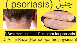 3 Best Homeopathic medicine for psoriasis  Dr Asim Raza Homoeopathic physician [upl. by Coleen]