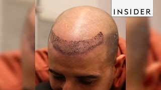 Scalp micropigmentation is a nonsurgical hair loss treatment [upl. by Annala]