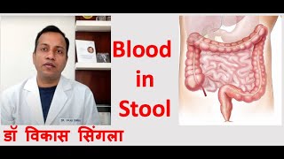 Reason for Blood in Stool  Causes and Treatment in Hindi [upl. by Liagibba]