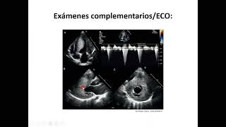 Cardiología 20 Miocardiopatías y Miocarditis [upl. by Ellivnarg]