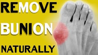 How to Treat Bunions 3 Simple Methods to Get Rid of Bunions  Without Surgery [upl. by Enihpled]