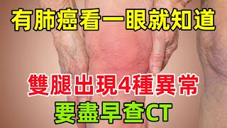 有沒有肺癌，看一眼就知道？雙腿經常出現這4種異常，要盡早查CT健康常識養生保健健康健康飲食 [upl. by Zetram]