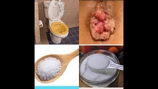 How To Treat Hemorrhoids At Home Naturally within 24 to 72 hours relief [upl. by Weintrob]