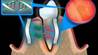 The term Periodontosis is not a correct medical term [upl. by Oznole927]