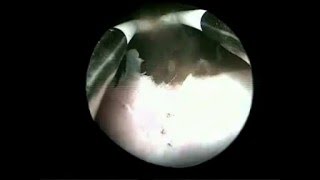 Hysteroscopic drainage of myometrial cystic adenomyosis [upl. by Alphonso164]