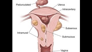 Uterine Fibroids Types and Treatments  Intramural Submucosal and Subserosal Fibroid [upl. by Enahs]