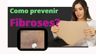 Fibroses pós lipoescutura abdominoplastia Como prevenir É importante usar talas placas [upl. by Templas597]