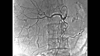 Angiography  Abdominal RSMDSA Pendelum Mode [upl. by Meuser]