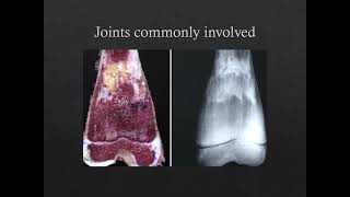 Gauchers Disease involving the MSK System [upl. by Htebsle324]