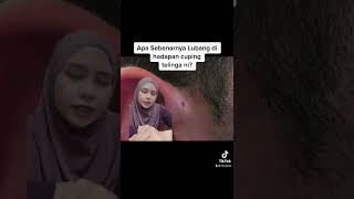 Doctor ENT  Apa itu lubang di hadapan cuping telinga Preauricular sinus [upl. by Annohs677]