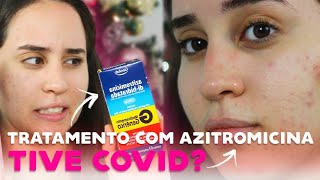 TRATAMENTO COM AZITROMICINA PARA ACNE [upl. by Aninad948]