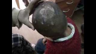 Scalp Eczema cured By Homeopathy DrRavi Singh [upl. by Ramirolg]