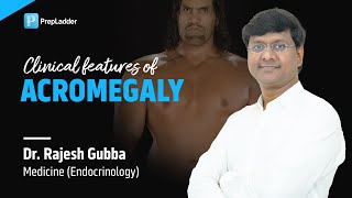 Clinical features of Acromegaly  Medicine Endocrinology by Dr Rajesh Gubba [upl. by Tarr]