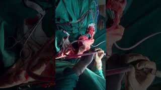 craniotomy surgeryshort video virallike share Subscribe amp follow 👍 [upl. by Eilloh]