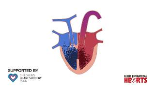 Tetralogy of Fallot [upl. by Harriman150]