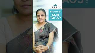 How to treat Skin Tag  Skin Tag removal  TAMIL  Dr Yamini  Helios skin hair amp laser clinic [upl. by Papert]