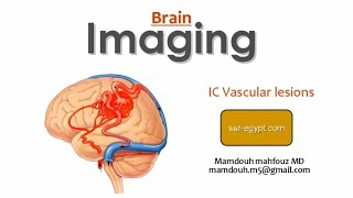 Imaging of intracerebral vascular lesions DRE Prof Mamdouh Mahfouz [upl. by Nangatrad]