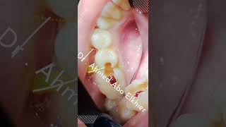 Single Visit Endodontic Treatment الكربولة endodontics dental [upl. by Oinotnanauj810]