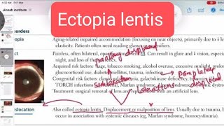 Ectopia lentis Opthalmology 7  First Aid USMLE Step 1 in UrduHindi [upl. by Veljkov363]