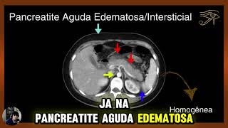 Achados Tomográficos na Pancreatite Aguda Edematosa [upl. by Yllac464]