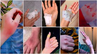 fake accident dp ideas 😭🤣😱hand bandage🥲 dp for girlsboys🙃hand injury bandage dp photo PicsCreation [upl. by Salomone803]