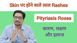 Skin पर होने वाले लाल Rashes  खुजली वाले लाल निशान  Pityriasis Rosea  P Rosea itchy red rashes [upl. by Darraj]