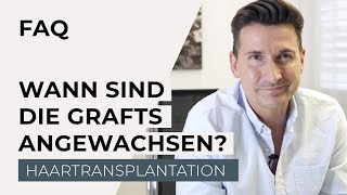 Haartransplantation  Wann sind die Haare fest angewachsen [upl. by Ydur]