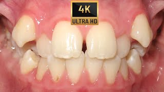 🤔HOW BRACES WORK Amazing TRANSFORMATION  TIMELAPSE four premolars extraction case Orthodontics❗ [upl. by Hannavas]