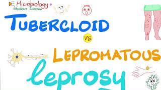 Leprosy  Tuberculoid Leprosy vs Lepromatous Leprosy  Comparisons Playlist [upl. by Aikahc]