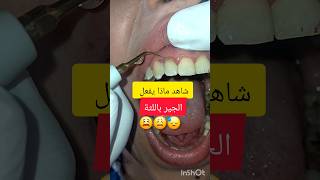 جير الاسنان سبب التهاب لثة شديد dentist stitch اكسبلور stitchfan ترند stitchlover dentistry [upl. by Attenna399]