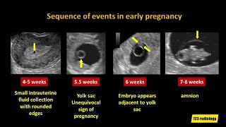 Early Pregnancy Failure A simplified Ultrasound Approach [upl. by Alva876]