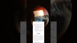 blepharitis trending viral [upl. by Grassi615]