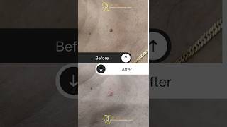 Skin tag removal by electrocautery  painless and bloodless removal [upl. by Gemma28]