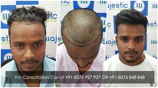 Receding Hairline  Most Natural Hairline Design amp Hair Transplant Results [upl. by Adiaroz841]