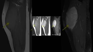 Musculoskeletal fibromatosis mrielbow anatomy [upl. by Alex]