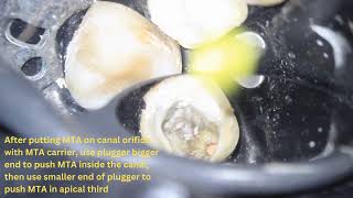 MTA Apical Plug Mandibular 1st Molar Distal Canal [upl. by Singhal117]