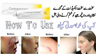 contractubex  contractubex gel  contractubex gel how to use  contractubex gel for acne scars [upl. by Yannodrahc]