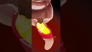 How Appendicitis Happens  appendix symptoms shorts  creativelearning3d [upl. by Martino]