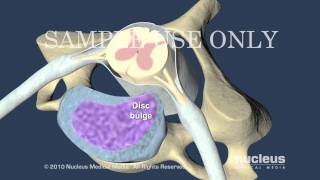 Cervical Disc Herniation [upl. by Thane]