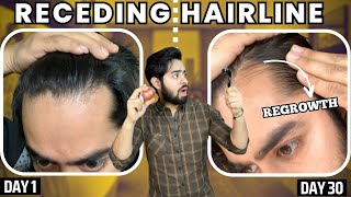 सिर्फ 1 महीने मैं RECEDING HAIRLINE REGROW करो  30 days HAIRLINE REGROWTH challenge [upl. by Deck]