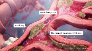 What Is Severe Asthma [upl. by Flan]