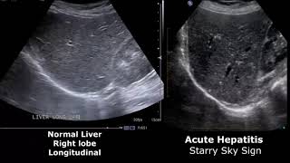 Liver Ultrasound Normal Vs Abnormal Image Appearances Comparison  Liver Ultrasound Pathologies [upl. by Sera]