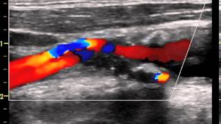 CAROTID ARTERY UNSTABLE PLAQUE quotAT RISKquot [upl. by Zimmermann]